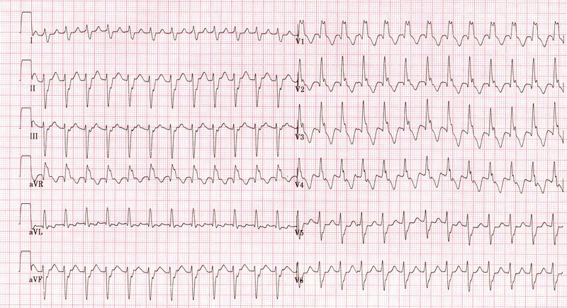 Elektrocardiografisch tracé