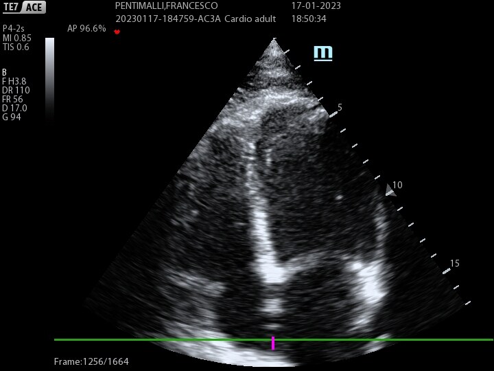 Echocardiogram color-doppler