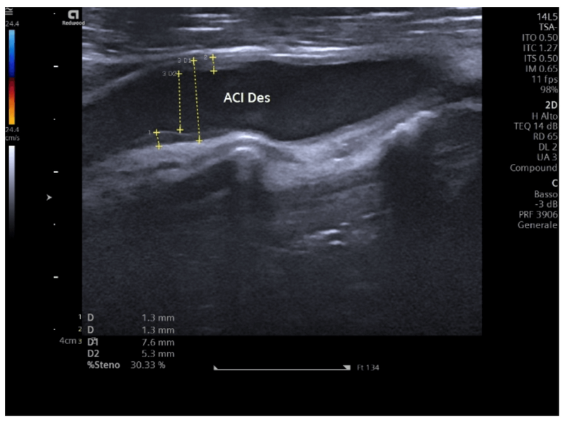 Ecodoppler van de supraaortale stammen